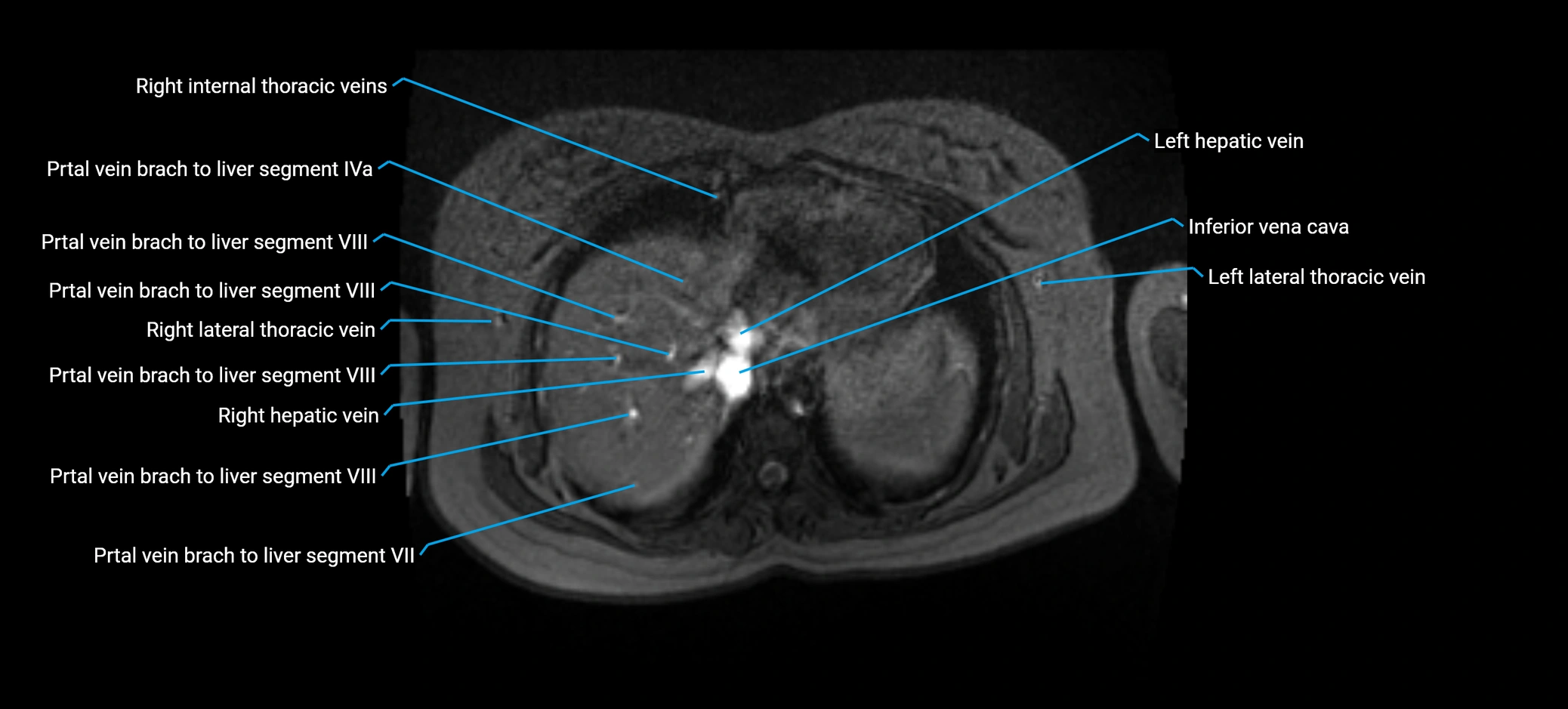 MRV abdomen pelvis & lower limb axial cross sectional anatomy labelled MRI image 17 (1).webp